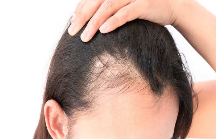 Evaluation of Hair Loss