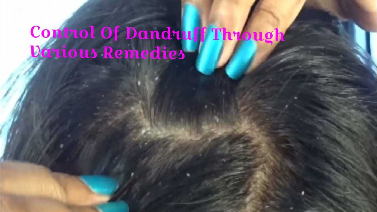 Control Of Dandruff Through Various Remedies