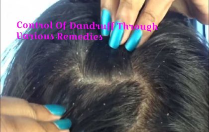 Control Of Dandruff Through Various Remedies